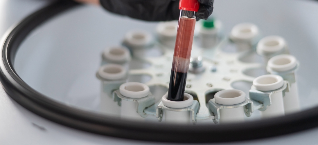 Un grand pas en avant grâce aux biomarqueurs